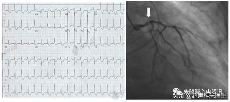 t波倒置9个真相图解,t波倒置判断口诀