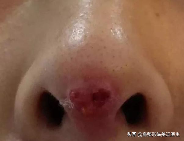 为什么医生都反对线雕隆鼻,到底要不要做线雕隆鼻