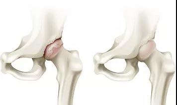 胯骨疼站立时间长了麻,胯骨痛走路都疼怎么回事