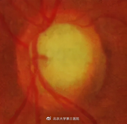 视野不丢，生活无忧|“大夫，我最近看灯光时四周总是有彩虹一样的七彩光晕，有问题吗？”