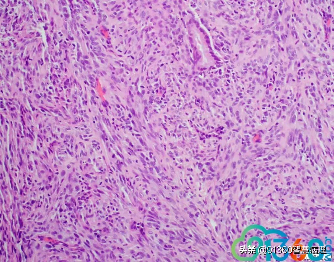 宫颈腺癌silvaa型用化疗吗,宫颈腺癌silvab型需要放疗几次