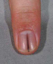 小小的指甲隐藏大大的健康秘密,小小指甲大调查