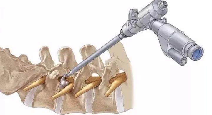 腰椎间盘突出症是怎么回事？一定要手术吗？能做微创治疗吗？