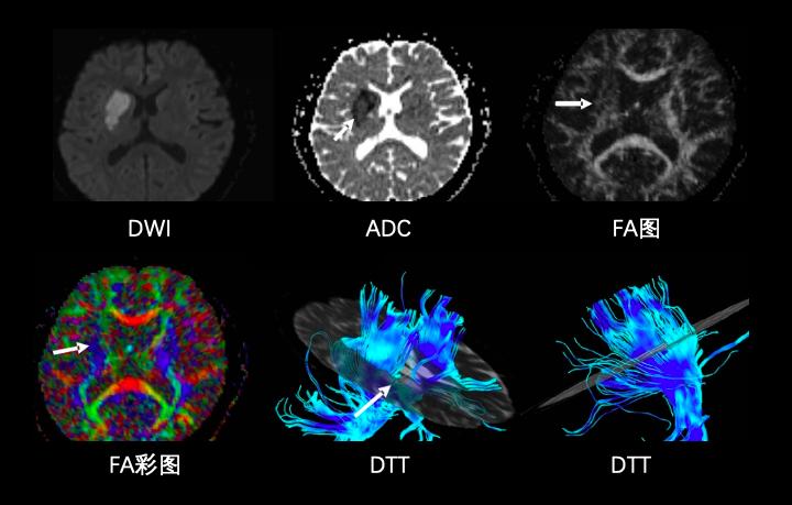 磁共振dti融合成像,磁共振dti成像作用