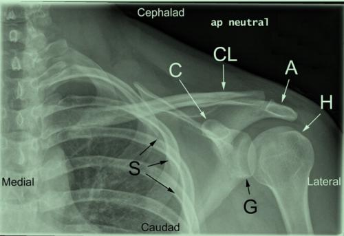 肩锁关节脱位复位视频,肩锁关节脱位固定带