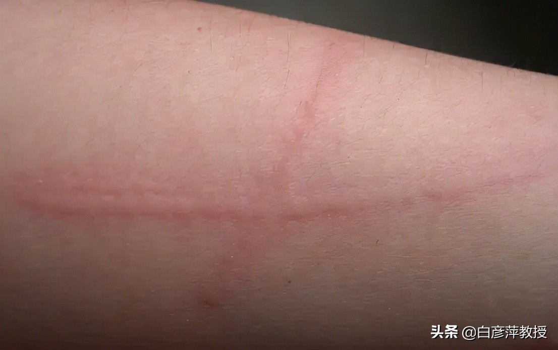 轻轻一划皮肤就会出现红痕,划皮肤出现红色印子是划痕症吗