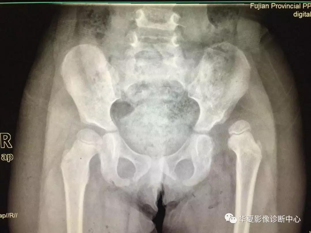 先天性髋关节脱位,先天性髋关节脱位属不属于残疾人