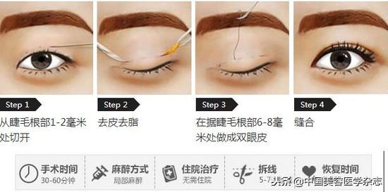 割了双眼皮还可以做微整形吗,割双眼皮是整容还是医美