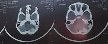 硬膜外血肿意识清醒需要手术吗,急性硬膜外血肿可做什么检查