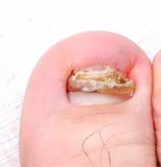 灰指甲应该怎么治医生教你三招,灰指甲为什么会得的