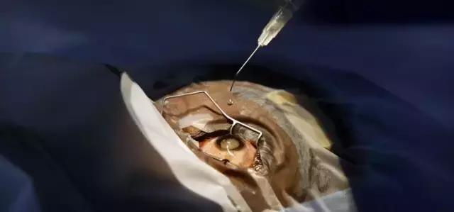 假性近视是真的近视了吗,假性近视是骗局吗