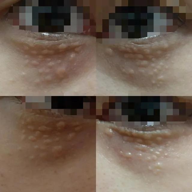 你长得真的是脂肪粒吗？如何解决“脂肪粒”？