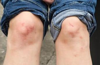 半月板撕裂要不要去修复,内侧半月板撕裂会切除多少半月板