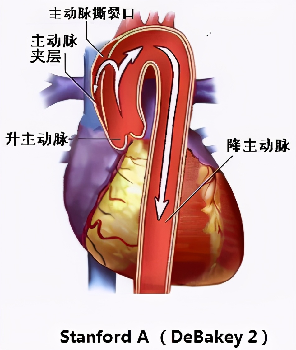 病例精选|体外开窗自制内嵌式三分支支架全腔内修复