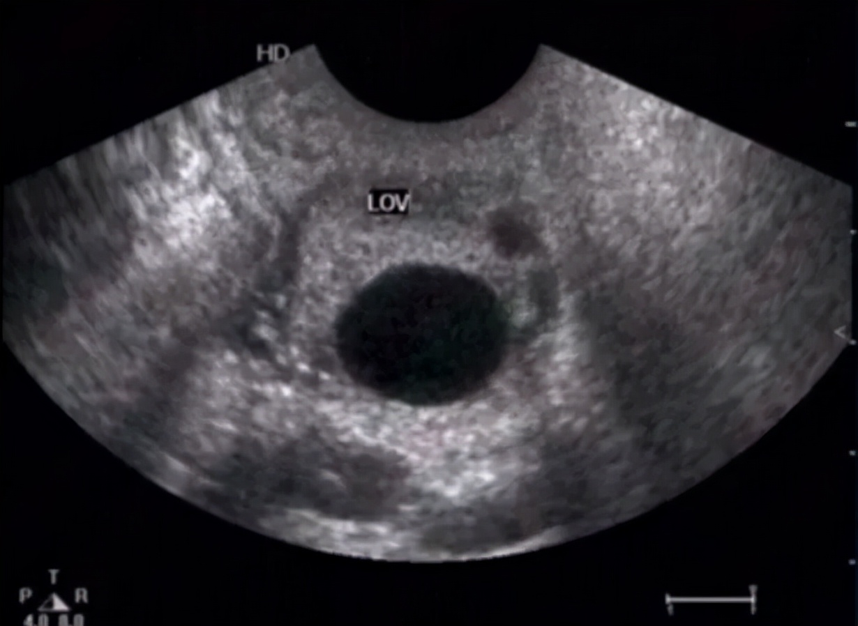 生完娃体检出现卵巢囊肿,卵巢囊肿可以通过教育局体检吗