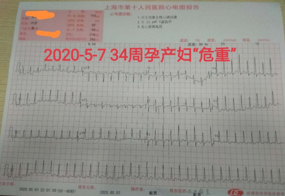 孕妇心动过速外加有点心肌缺血,怀孕心电图窦性心动过速心慌胸闷