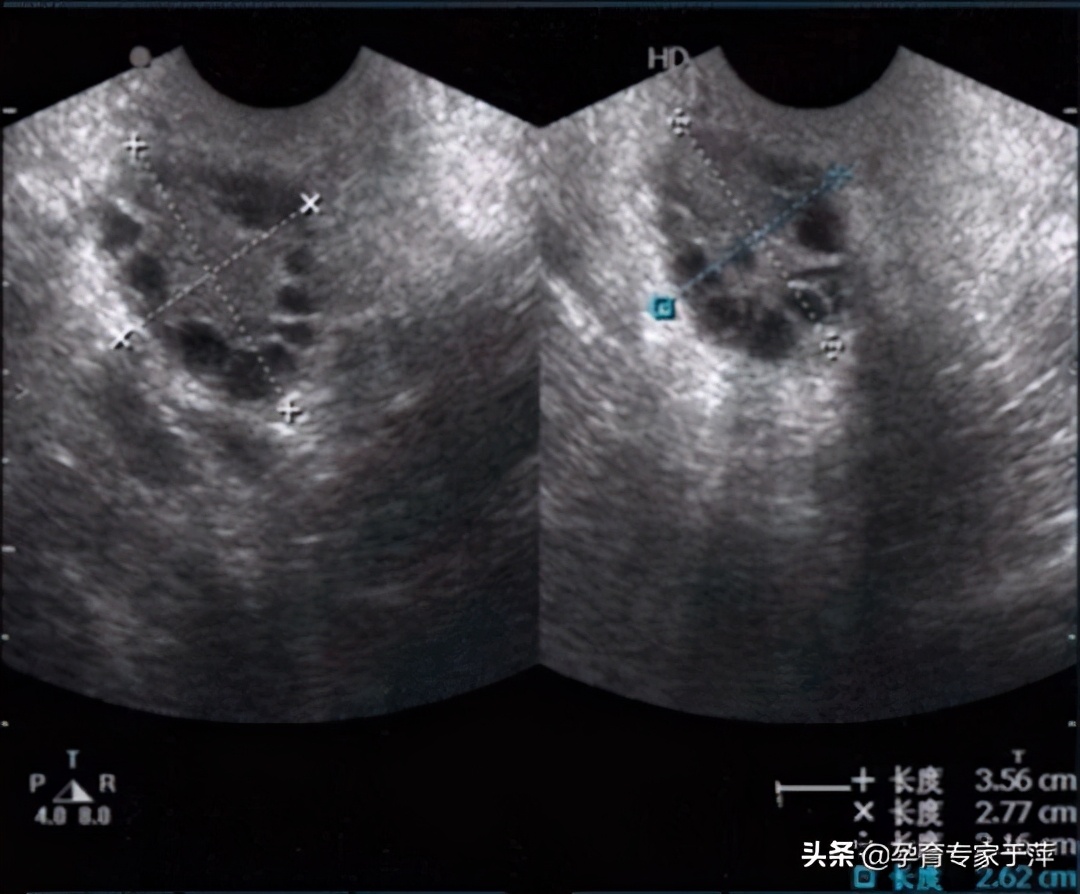 于萍治疗不孕,多囊卵巢综合征的症状和解决