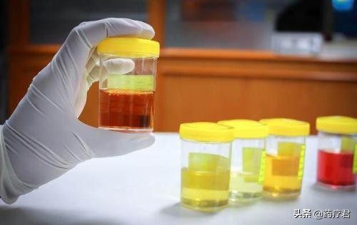 高血压肾病的早期表现尿色深,肾病综合征尿色发白正常吗