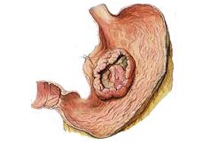 胃癌如何控制复发转移，实现长期生存？辅助治疗是关键！