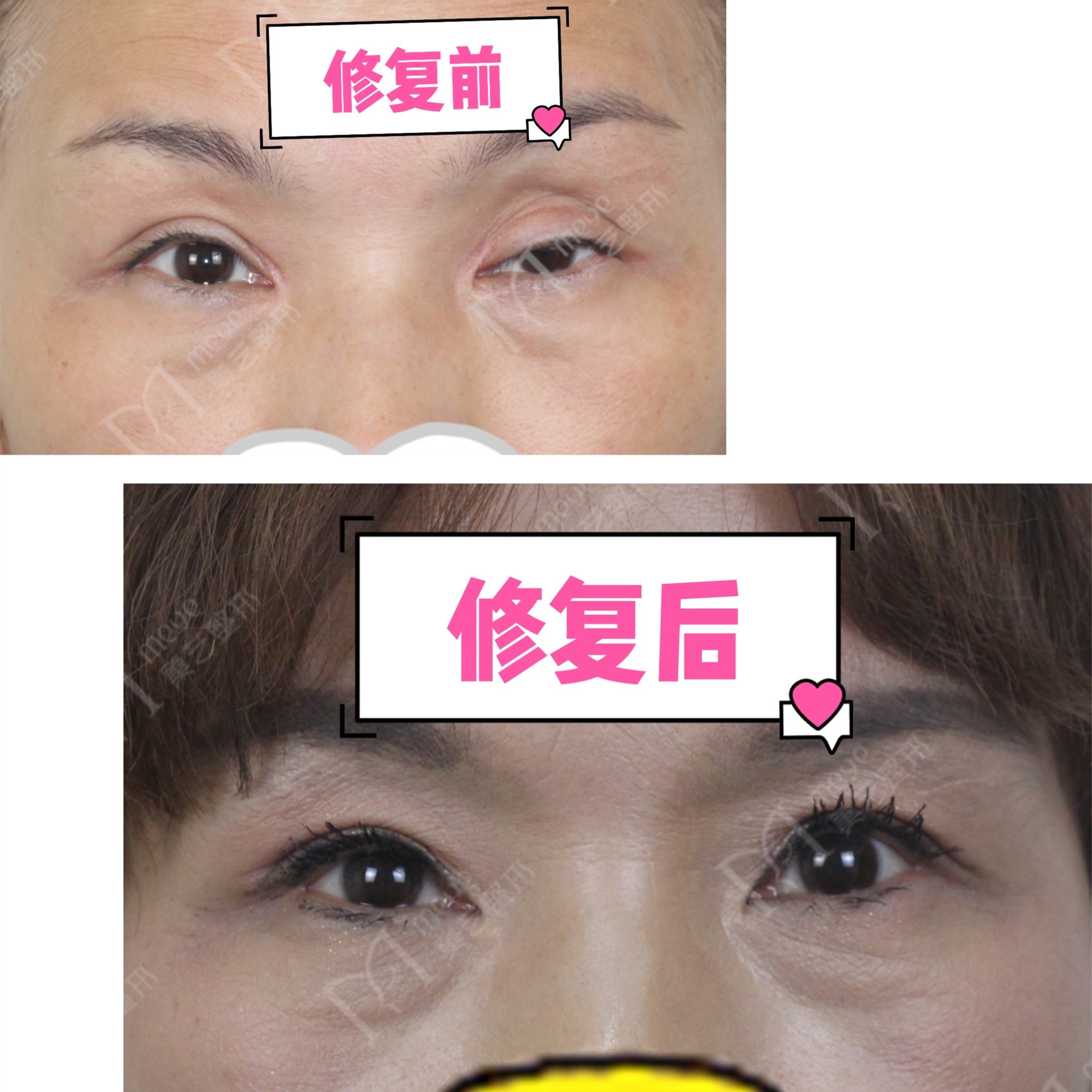 双眼皮失败了怎么修复好,双眼皮修复失败怎么解决