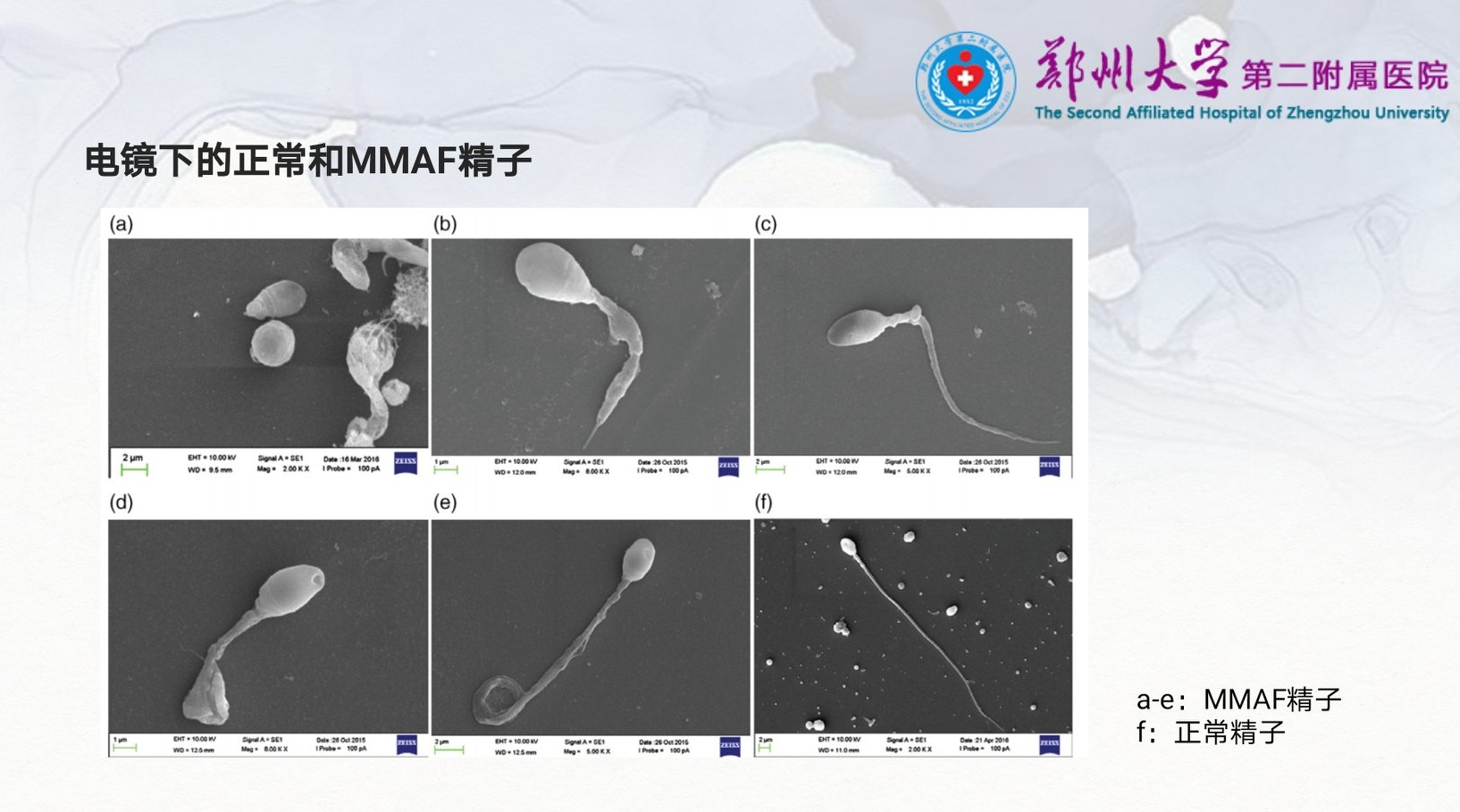 严重弱精症原因,重度少精弱精症可能的原因