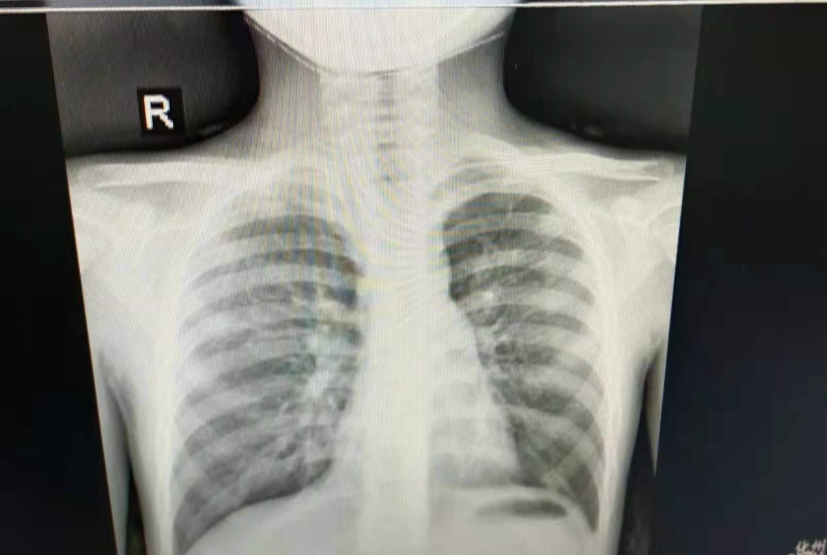 小孩9岁出气喘是怎么回事,9岁孩子气喘厉害