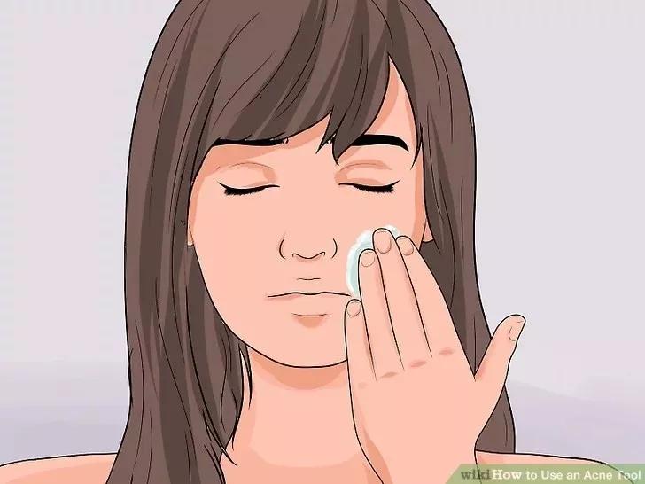 针清祛痘一般多少钱一次,针清祛痘后可以涂甲硝唑吗