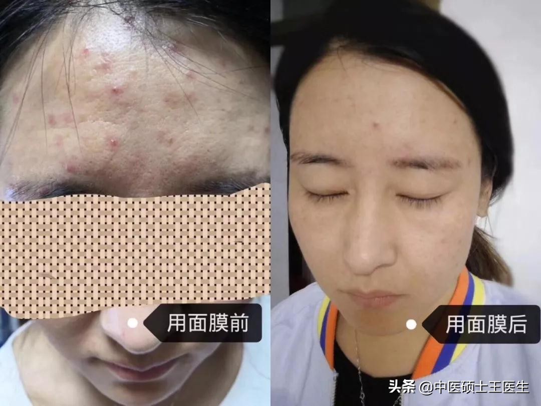 中医祛痘多少钱,中医祛痘挂什么科