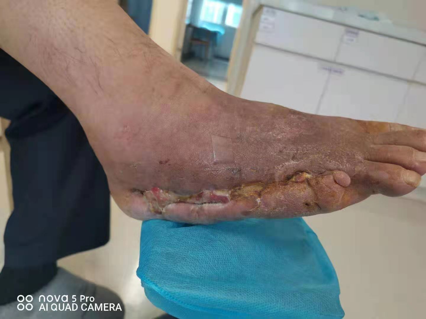 中西医结合治疗糖尿病,糖尿病足中西医结合指南