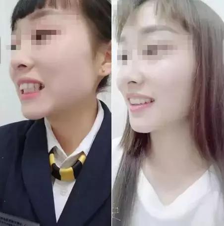 湖北种植牙齿多少钱一个,最新武汉种植牙齿多少钱一颗