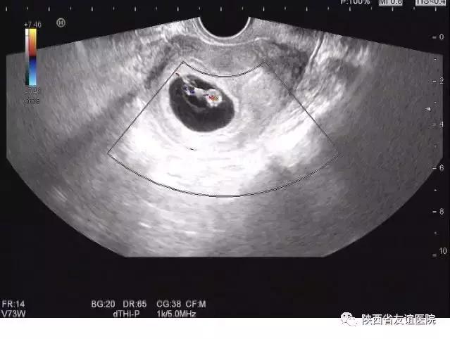 孕妇超声检查的几大误区,孕妇12周超声检查图片怎样看