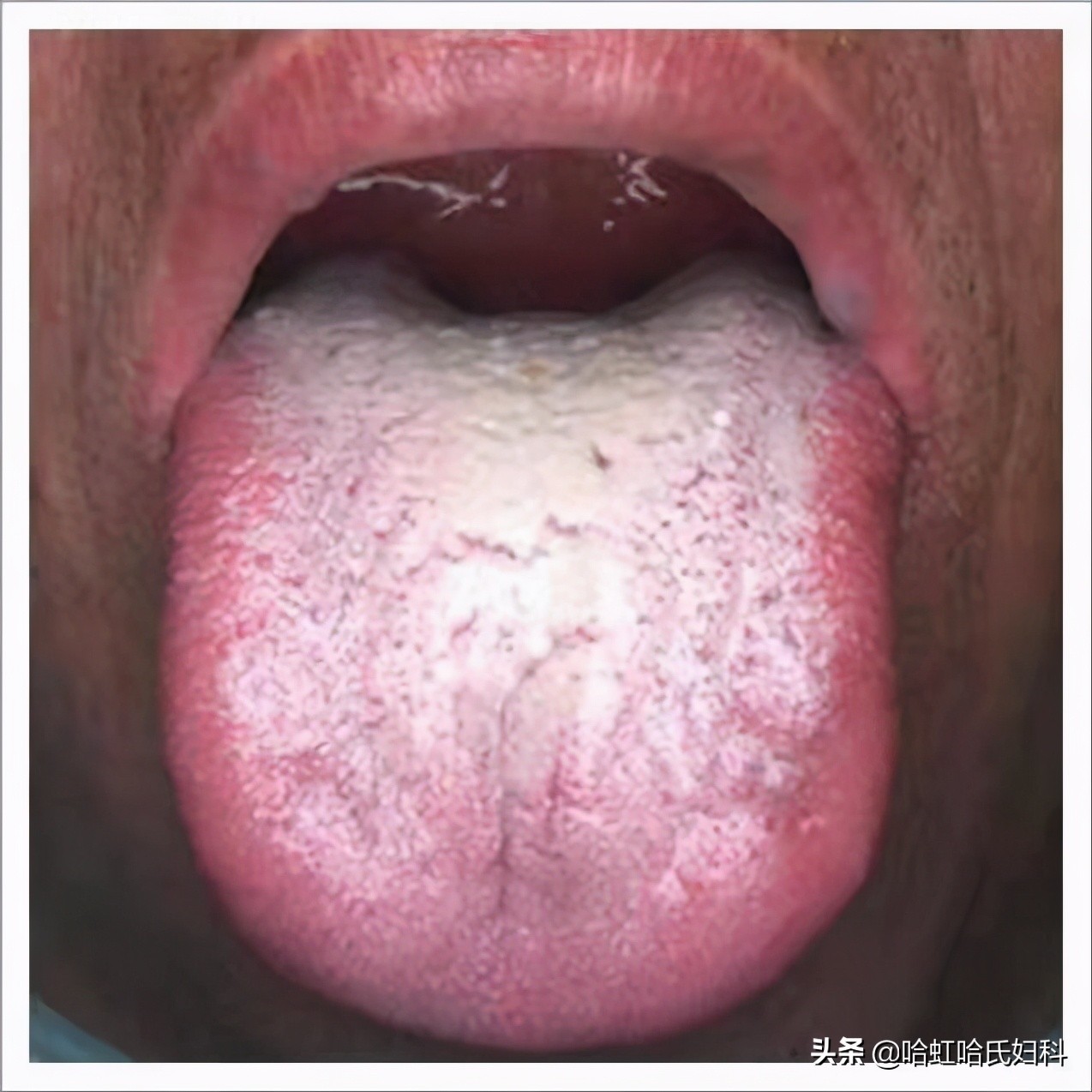 中医的五种方式告诉你是否脾虚,一招教您判断体内湿气