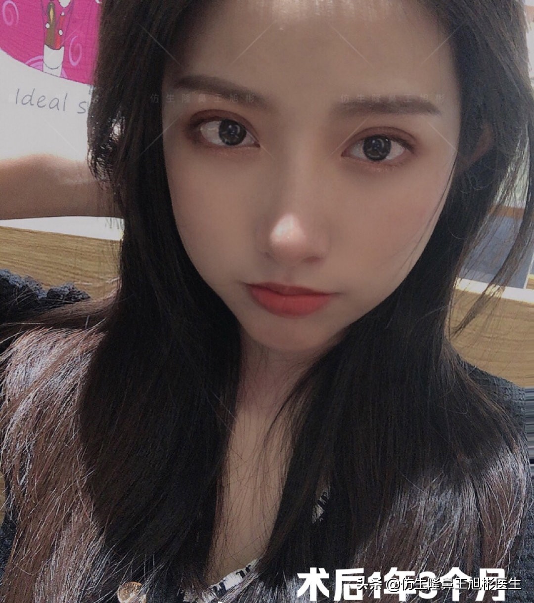 手术鼻头增厚能用什么方法弄,大鼻头高鼻梁缩小手术案例