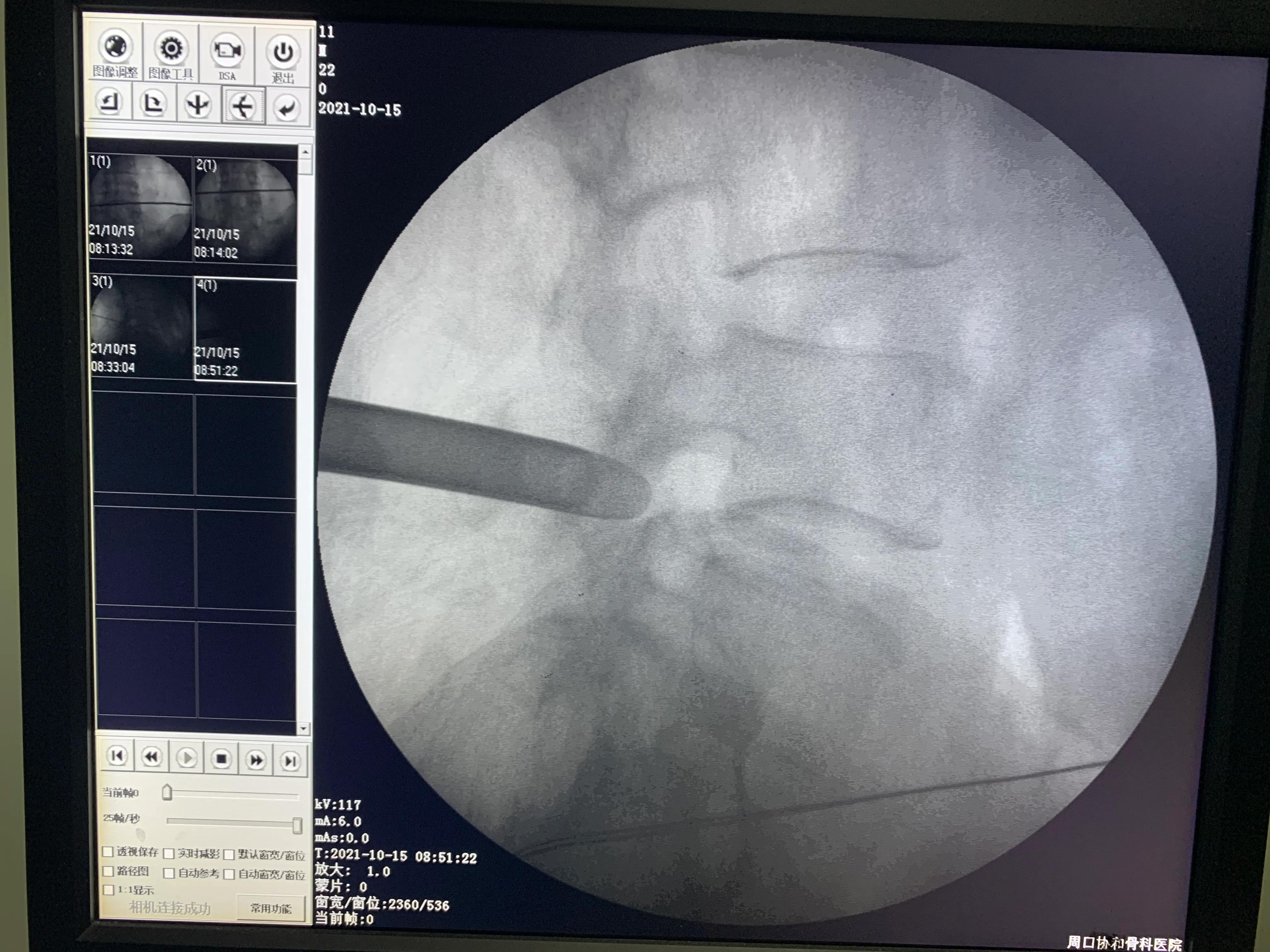 椎间孔镜术后腰痛症状多久消失,盘源性腰痛手术后易复发吗
