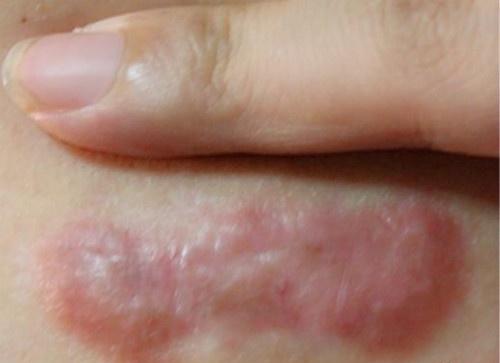 疤痕疙瘩淡化颜色的方法,氢醌乳膏能祛除疤痕红印吗