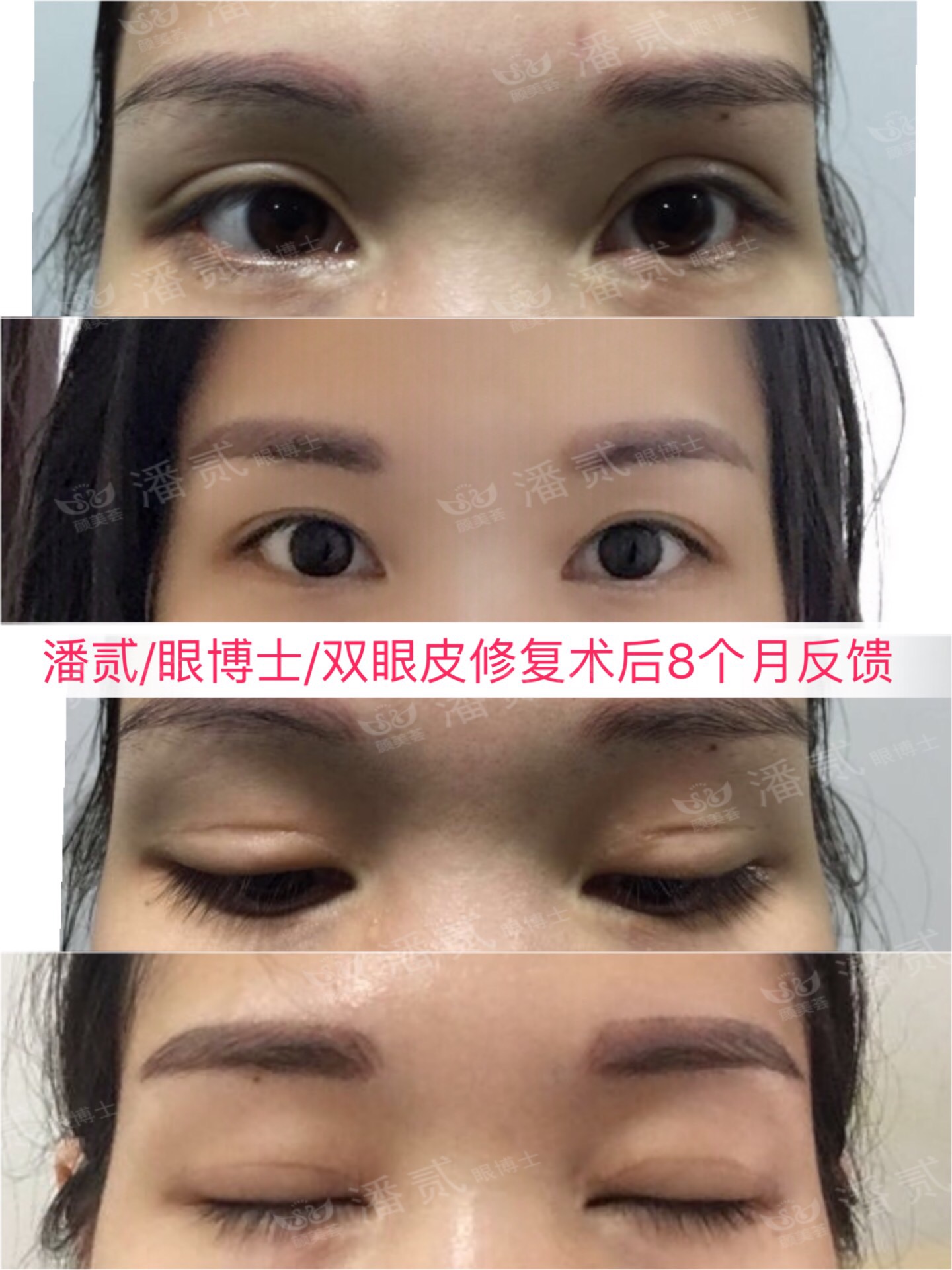 请别再怀疑潘贰做双眼皮手术切肌肉了，希望这是我最后一次澄清