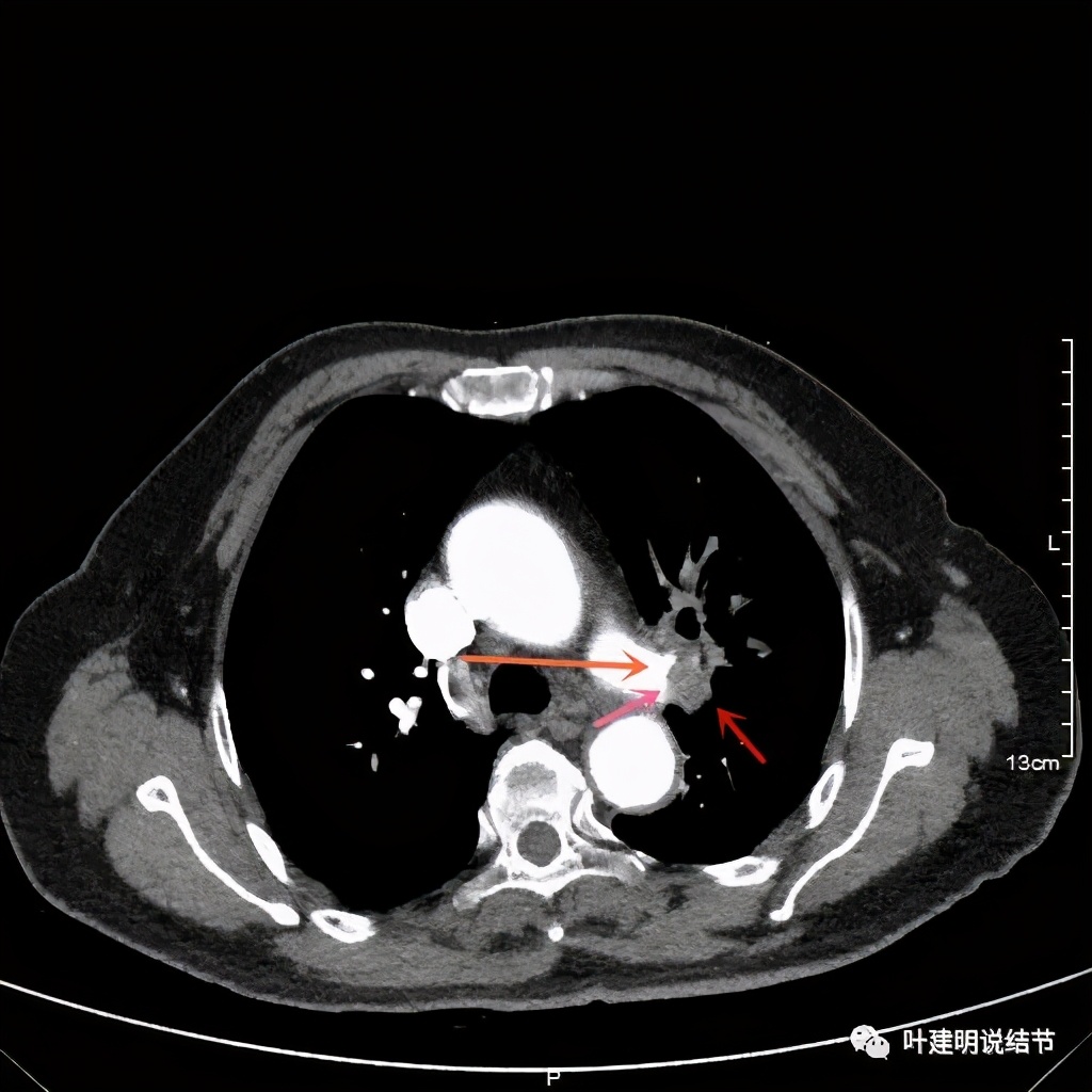 卡瑞利珠单抗治疗肺鳞癌有用吗,特瑞普利单抗对鳞癌治疗有效吗