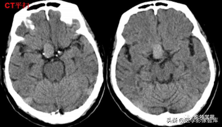 鞍区肿瘤做什么检查得出来,鞍区肿瘤的影像学鉴别
