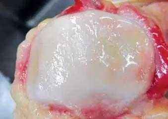 髌骨软化是看中医还是西医,骨科髌骨软化治疗