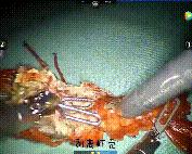 林黛玉重病咳血,林黛玉肺癌