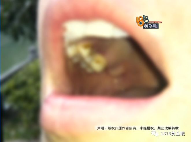 两次拔牙中间需要间隔多久,两次拔牙必须是一个医生吗