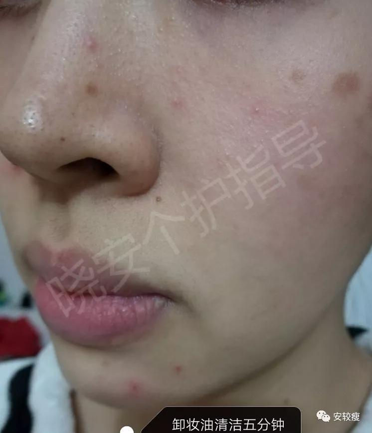 皮炎疹子干燥泛红,秋冬皮肤泛红发烫