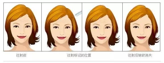 高效的面部除皱方法你选对了吗,现在最好的面部除皱是用什么方法