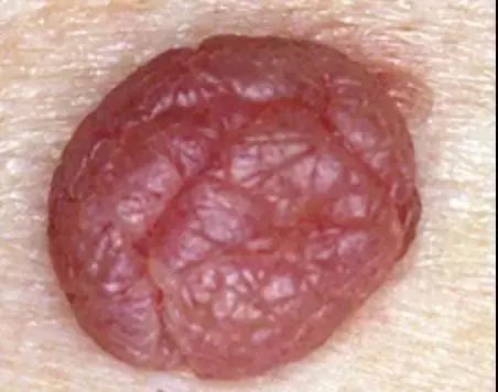 身上长小肉粒可以抠掉吗?小肉粒“偏爱”这些人