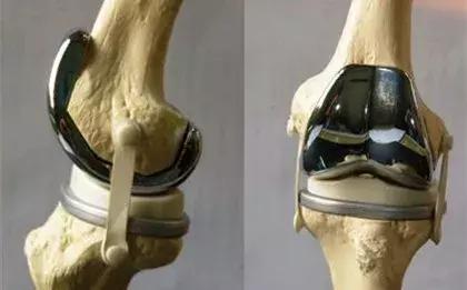 膝关节问题讲解,关于关节炎的问题