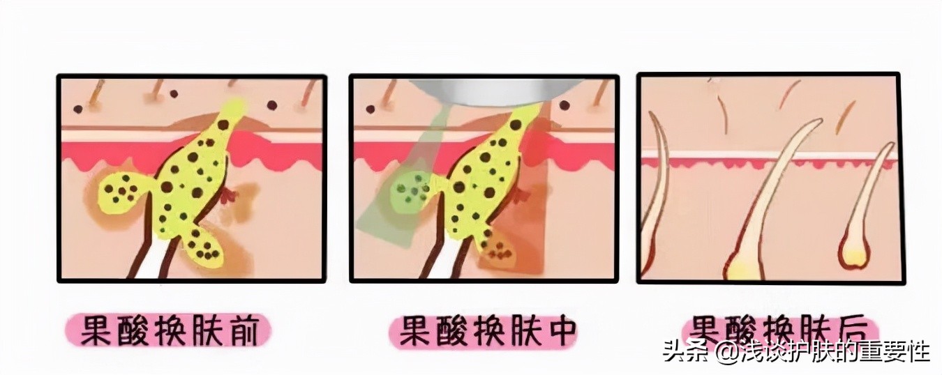 皮肤光滑细腻去角质,去角质可以让脸变白吗