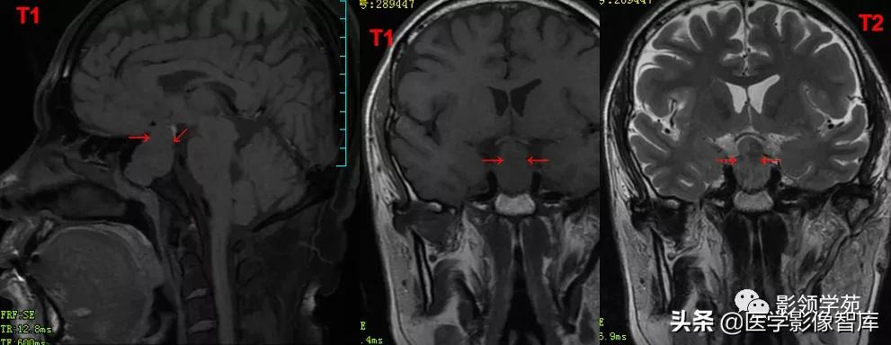 鞍区肿瘤做什么检查得出来,鞍区肿瘤的影像学鉴别