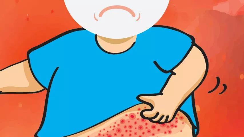 皮肤痒使用的软膏推荐,治疗皮肤痒的药膏对照大全