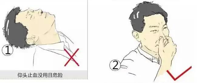 正确治疗鼻出血,有什么方法快速治疗鼻出血