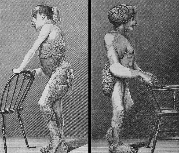 怪病无法直立行走,身患怪病无人能医